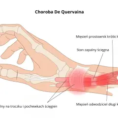 Zapalenie pochewki ścięgna nadgarstka (choroba De Quervaina) - ilustracja pokazuje stan zapalny ścięgien kciuka, wskazujący na potrzebę leczenia.