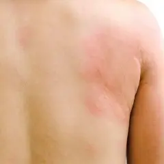 Objawy tocznia rumieniowatego: poznaj pierwsze niepokojące symptomy choroby
