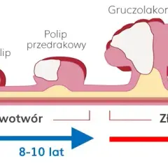Stolec przy raku jelita grubego: kluczowe zmiany i objawy