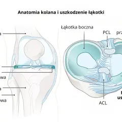 Anatomia kolana z widocznym podłużnym uszkodzeniem łąkotki przyśrodkowej.