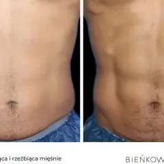 Przed i po zabiegu elektrostymulacji mięśni brzucha. Widoczna wyraźna poprawa definicji mięśni.