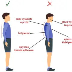 Ilustracja pokazuje prawidłową i nieprawidłową postawę. Nieprawidłowa postawa, z wysuniętymi barkami i głową, spłaszczoną klatką piersiową i płaską lordozą lędźwiową, może być objawem zesztywniającego zapalenia stawów kręgosłupa.