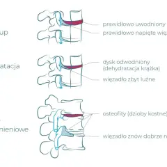 Ilustracja pokazuje zdrowe kręgi, odwodniony krążek i zmiany zwyrodnieniowe, które mogą być spowodowane pracą fizyczną.