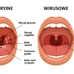 Jakie są objawy anginy bakteryjnej i wirusowej? Charakterystyczne oznaki