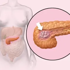 Niepokojące objawy raka trzustki: rozpoznaj symptomy na wczesnym etapie