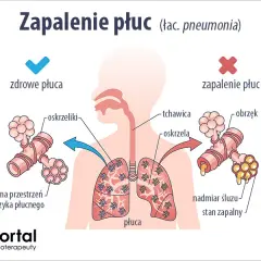 7 najgroźniejszych objawów zapalenia płuc, które musisz rozpoznać szybko