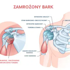 Zamrożony bark: pogrubienie, zwłóknienie i obkurczenie torebki stawu ramiennego wyjaśnia, dlaczego bolą ramiona.