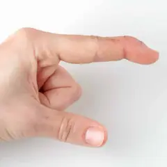 Krzywe palce u rąk na zdjęciach: objawy i typy deformacji