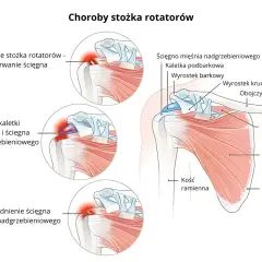 Ilustracja pokazuje budowę barku i schorzenia stożka rotatorów, w tym uszkodzenie, zapalenie i zwyrodnienie ścięgna mięśnia nadgrzebieniowego.