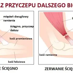 Naderwany biceps - objawy, które powinny cię zaniepokoić