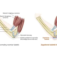 Ilustracja porównuje zdrowy łokieć z zapaleniem kaletki łokciowej. Widać obrzęk i płyn w łokciu po prawej stronie.