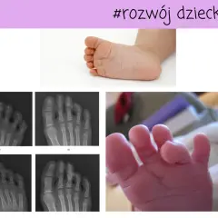 Krzywe palce u nóg dziecka - przyczyny i skuteczne leczenie