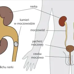 Jakie są przyczyny kamicy nerkowej? Poznaj czynniki ryzyka i zapobieganie