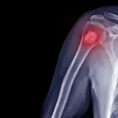 Najczęstsze objawy raka kości - co powinno Cię zaniepokoić i kiedy do lekarza
