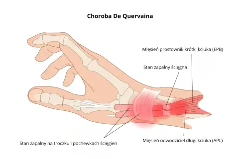 Zapalenie pochewki ścięgna nadgarstka (choroba De Quervaina) - ilustracja pokazuje stan zapalny ścięgien kciuka, wskazujący na potrzebę leczenia.