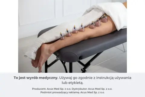 Zabieg stawiania baniek na kolanie. Kilka baniek próżniowych umieszczonych na łydce i udzie.