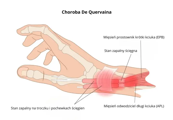 Zapalenie pochewki ścięgna nadgarstka (choroba De Quervaina) - ilustracja pokazuje stan zapalny ścięgien kciuka, wskazujący na potrzebę leczenia.