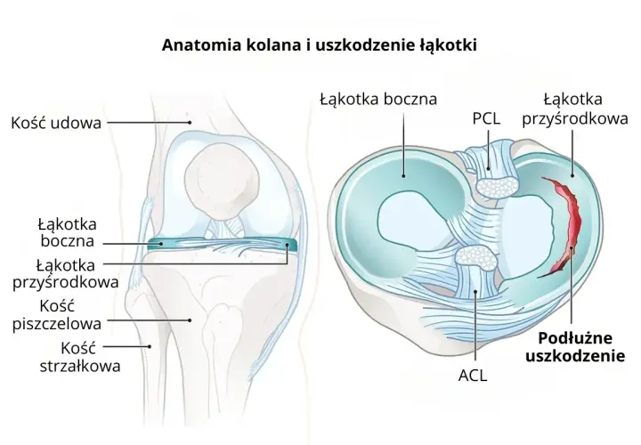 Anatomia kolana z widocznym podłużnym uszkodzeniem łąkotki przyśrodkowej.