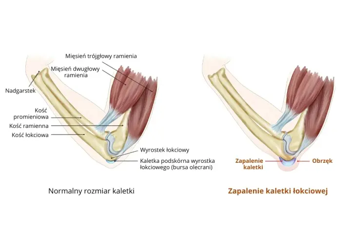 Porównanie zdrowego łokcia z zapaleniem kaletki łokciowej, pokazujące obrzęk i stan zapalny.