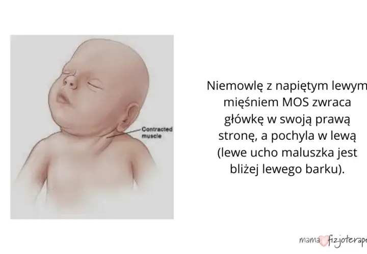 Rozpoznaj naciągnięcie mięśni karku u niemowlaka: najważniejsze objawy