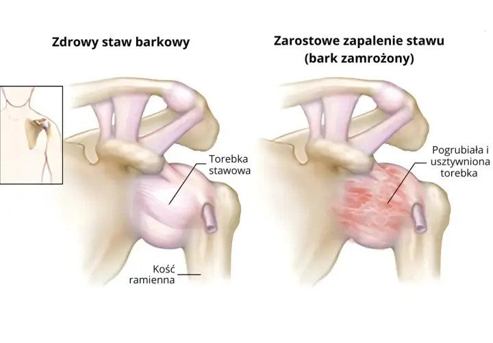 Porównanie zdrowego stawu barkowego z zapaleniem mięśnia barkowego (bark zamrożony), gdzie torebka stawowa jest pogrubiała i usztywniona.