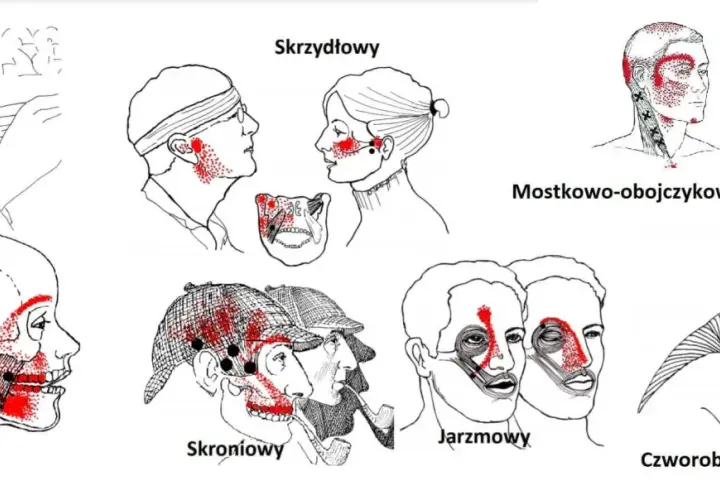 Ilustracje przedstawiają punkty spustowe bólu w mięśniach: policzkowym, żwaczu, skroniowym, jarzmowym, skrzydłowym i potylicznym.