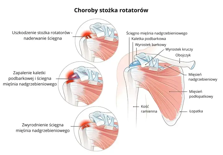 Ilustracja pokazuje budowę barku i schorzenia stożka rotatorów, w tym uszkodzenie, zapalenie i zwyrodnienie ścięgna mięśnia nadgrzebieniowego.