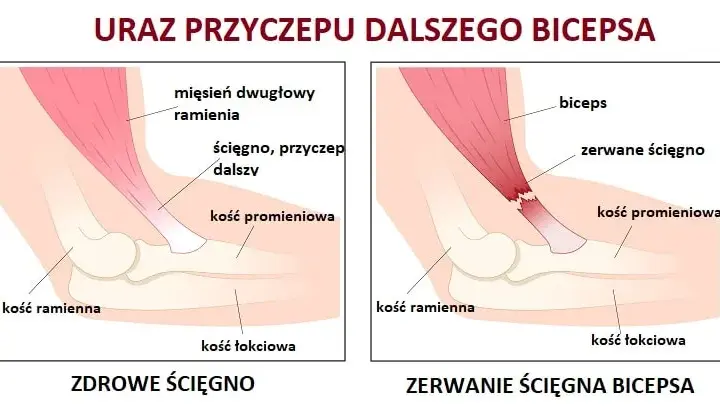 Naderwany biceps - objawy, które powinny cię zaniepokoić