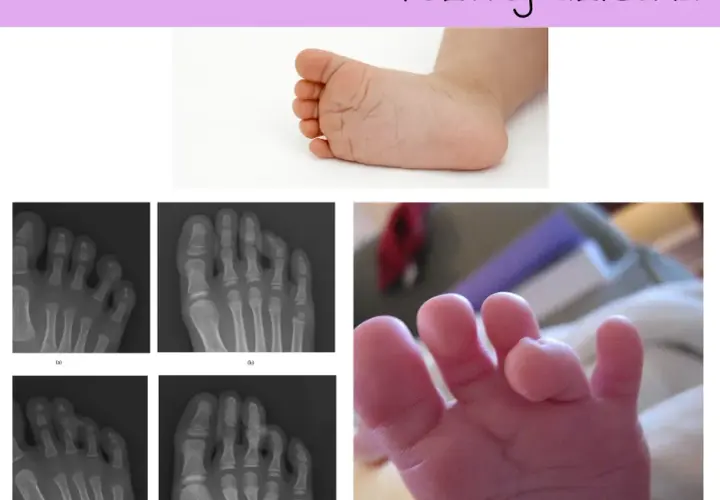 Krzywe palce u nóg dziecka - przyczyny i skuteczne leczenie