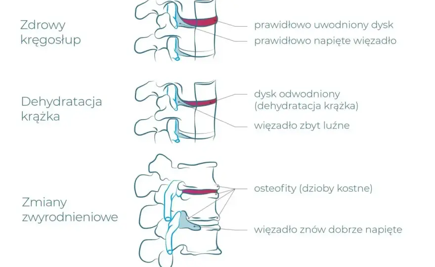 Zwyrodnienia kręgosłupa a praca - Czy Twoje plecy są bezpieczne?