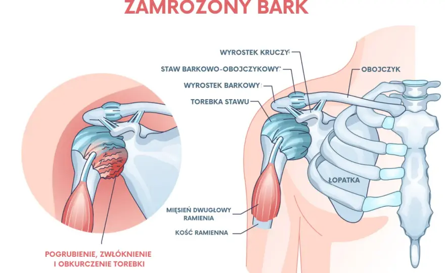 Dlaczego bolą ramiona - Przyczyny, objawy i kiedy do lekarza?
