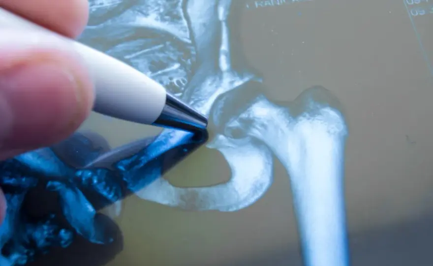 Bakteryjne zapalenie stawu biodrowego - pilna diagnoza i leczenie