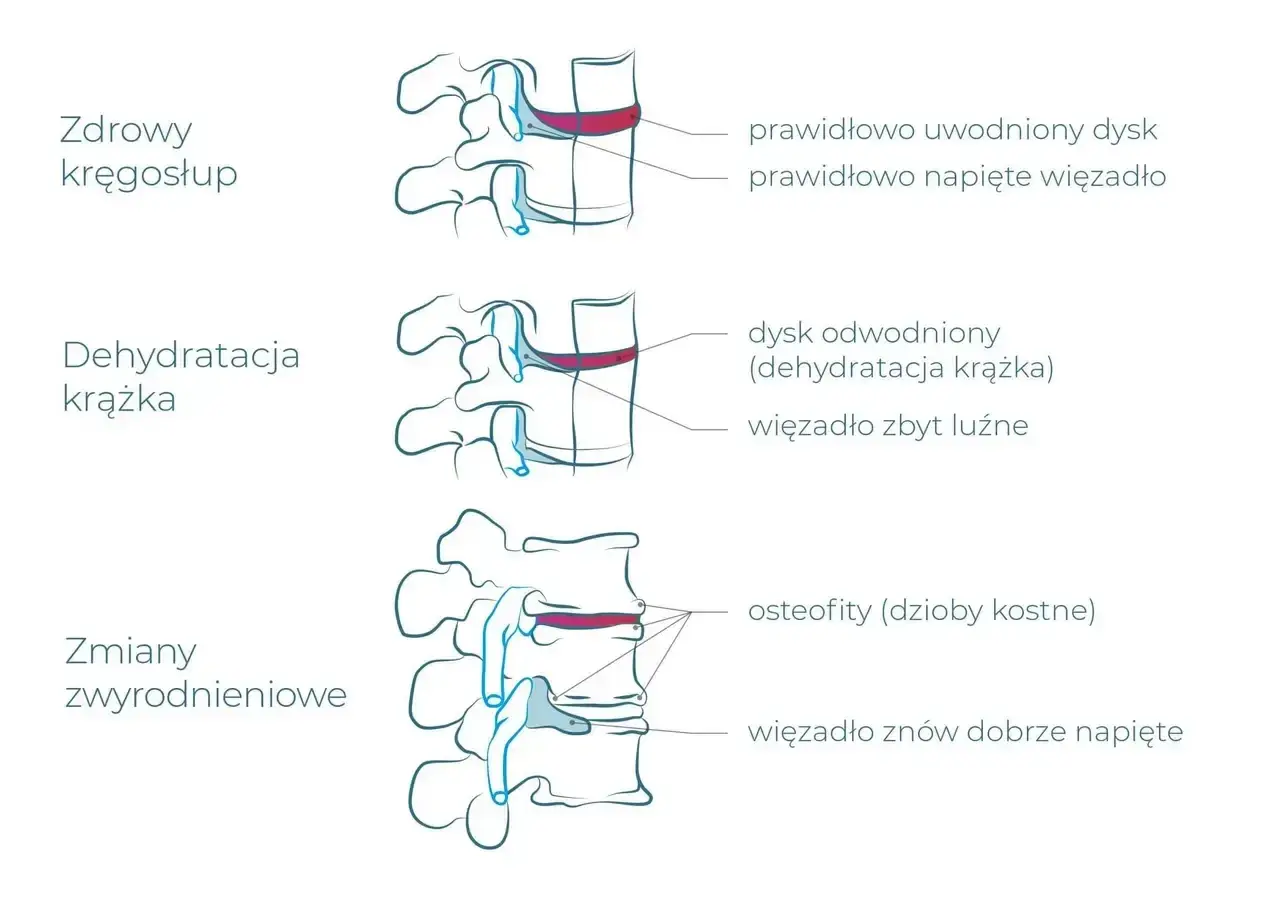Ilustracja pokazuje zdrowe kręgi, odwodniony krążek i zmiany zwyrodnieniowe, które mogą być spowodowane pracą fizyczną.