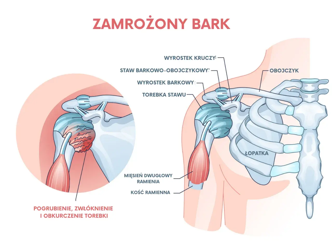 Zamrożony bark: pogrubienie, zwłóknienie i obkurczenie torebki stawu ramiennego wyjaśnia, dlaczego bolą ramiona.