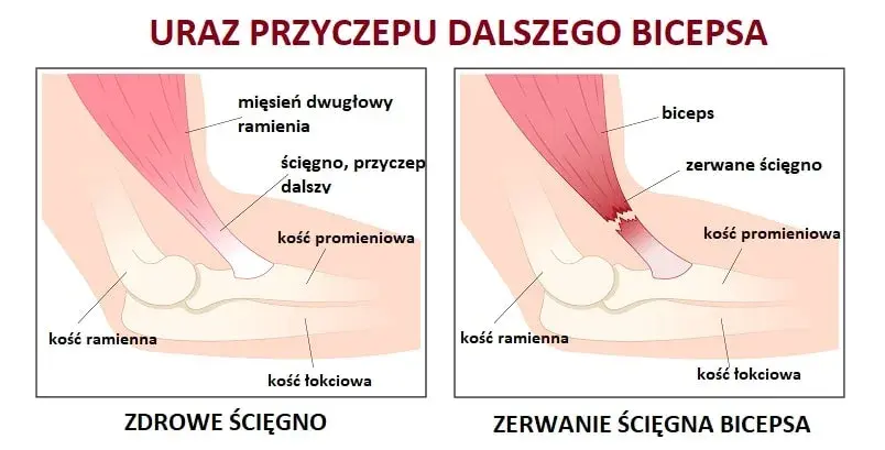 Naderwany biceps - objawy, które powinny cię zaniepokoić