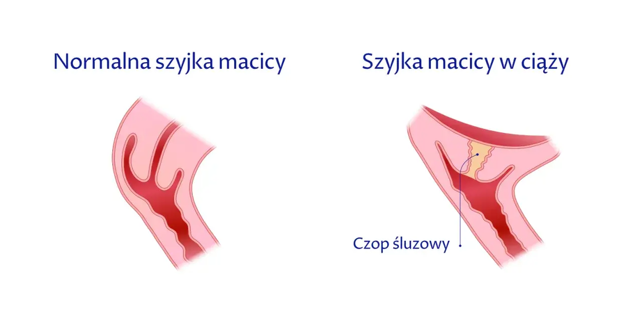 Jak skutecznie zapobiec skracaniu szyjki macicy w ciąży i uniknąć zagrożeń