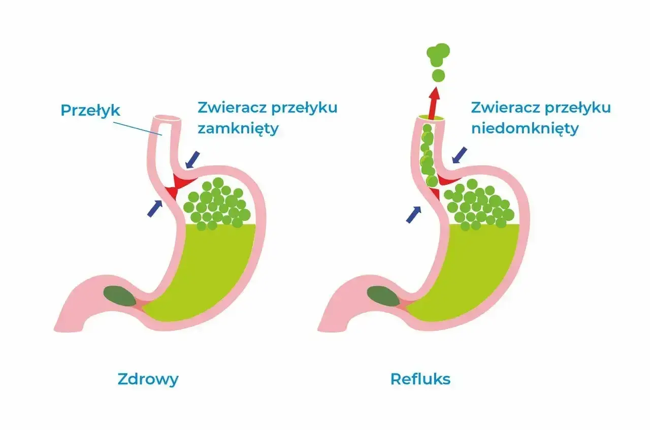 Ilustracja pokazuje refluks żołądkowo-przełykowy. Czy przy refluksie bola plecy? Czasem tak, objawy mogą być nietypowe.