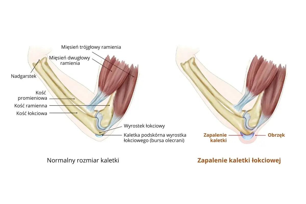 Porównanie zdrowego łokcia z zapaleniem kaletki łokciowej. Po prawej widoczny obrzęk i zapalenie kaletki.