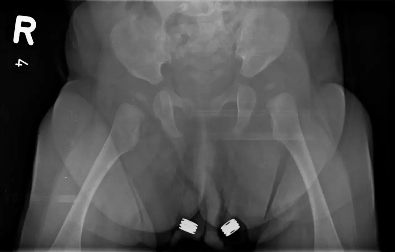RTG miednicy z widoczną dysplazją stawu biodrowego u starszych dzieci. Widoczne są dwa implanty w okolicy krocza.