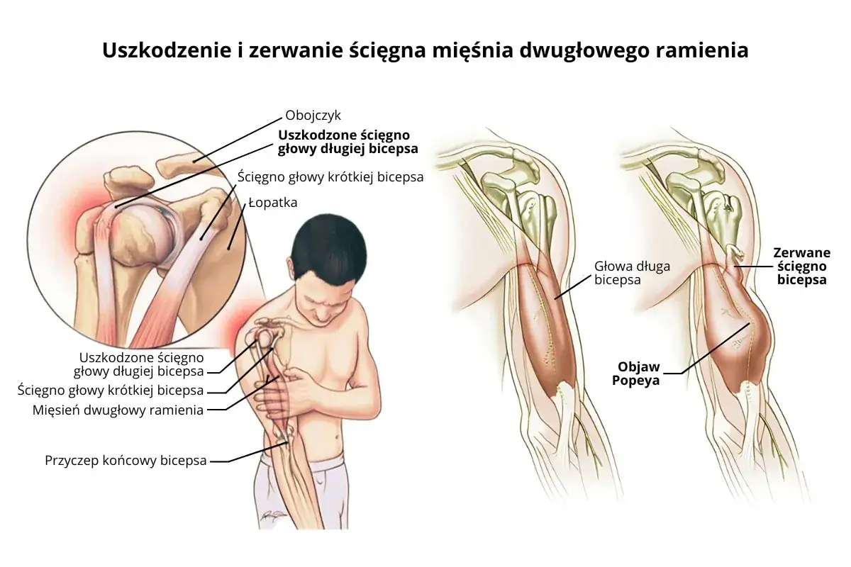 Ból ręki w ramieniu przyczyna: uszkodzone ścięgno bicepsa, zerwane ścięgno bicepsa, objaw Popeya.