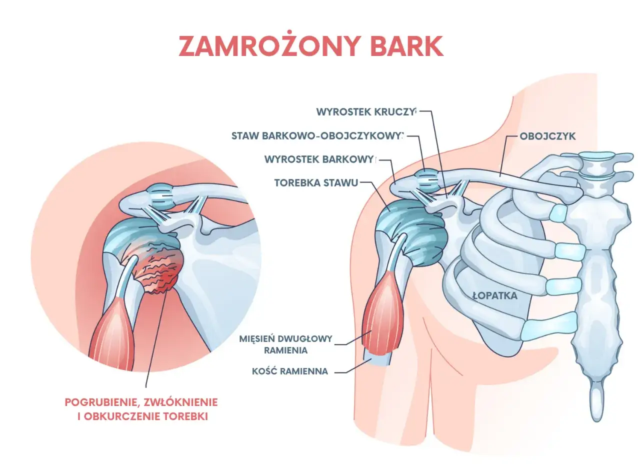 Ilustracja przedstawia zamrożony bark, ukazując pogrubienie, zwłóknienie i obkurczenie torebki stawu ramiennego.