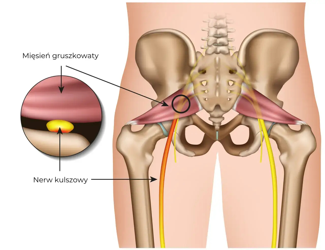 Anatomia bólu mięśnia gruszkowatego. Ilustracja pokazuje ucisk nerwu kulszowego przez mięsień gruszkowaty, klucz do tego, jak pozbyć się bólu.