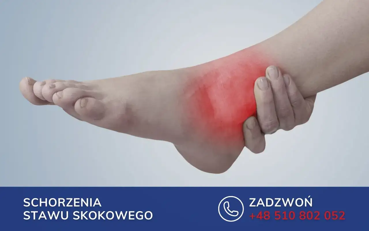 Dłoń uciska bolący, zaczerwieniony staw skokowy, wskazując na stan zapalny.