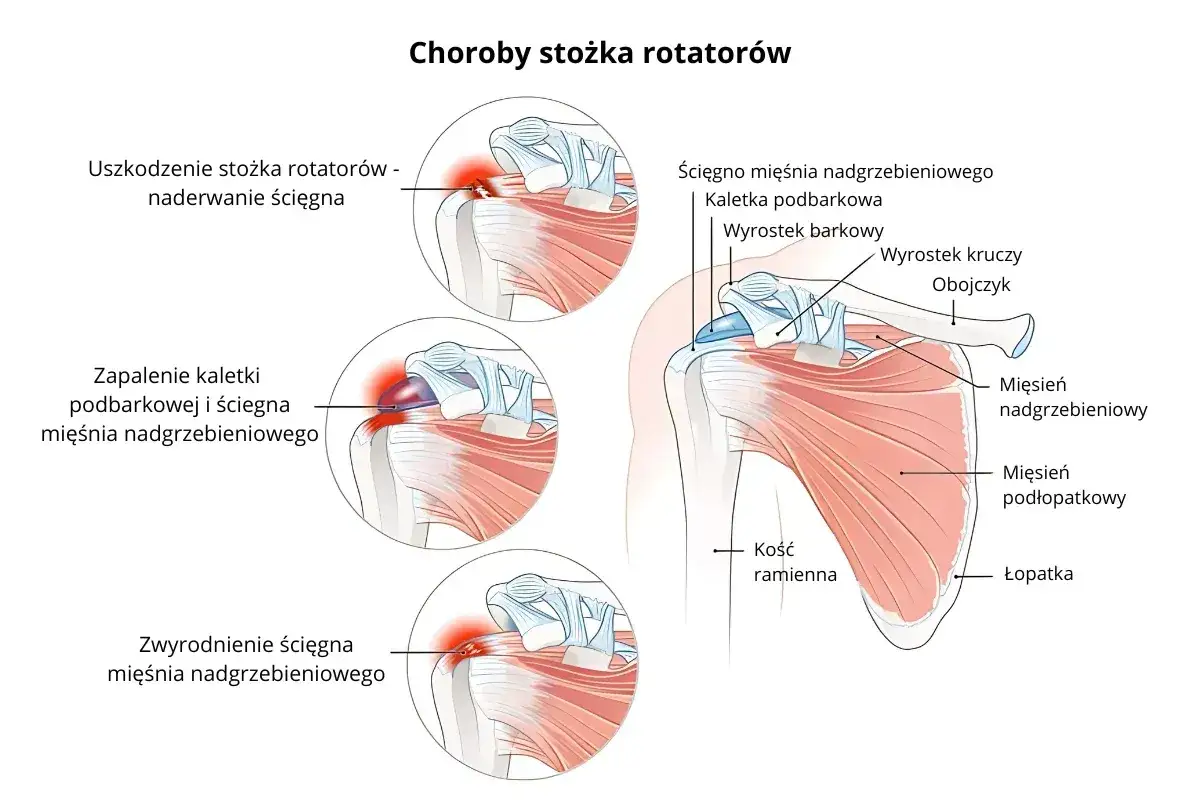 Ilustracja przedstawia budowę barku i schorzenia stożka rotatorów, w tym uszkodzenie, zapalenie i zwyrodnienie ścięgna mięśnia nadgrzebieniowego.