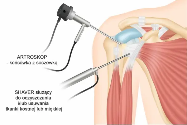 Artroskopia ramienia: artroskop i shaver pomagają zdiagnozować i leczyć ból ręki w ramieniu przyczyna.